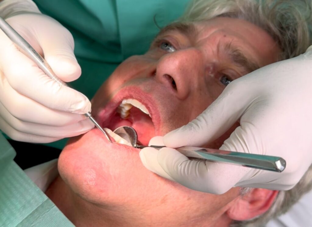 Pulizia dentale per prevenire la parodontite
