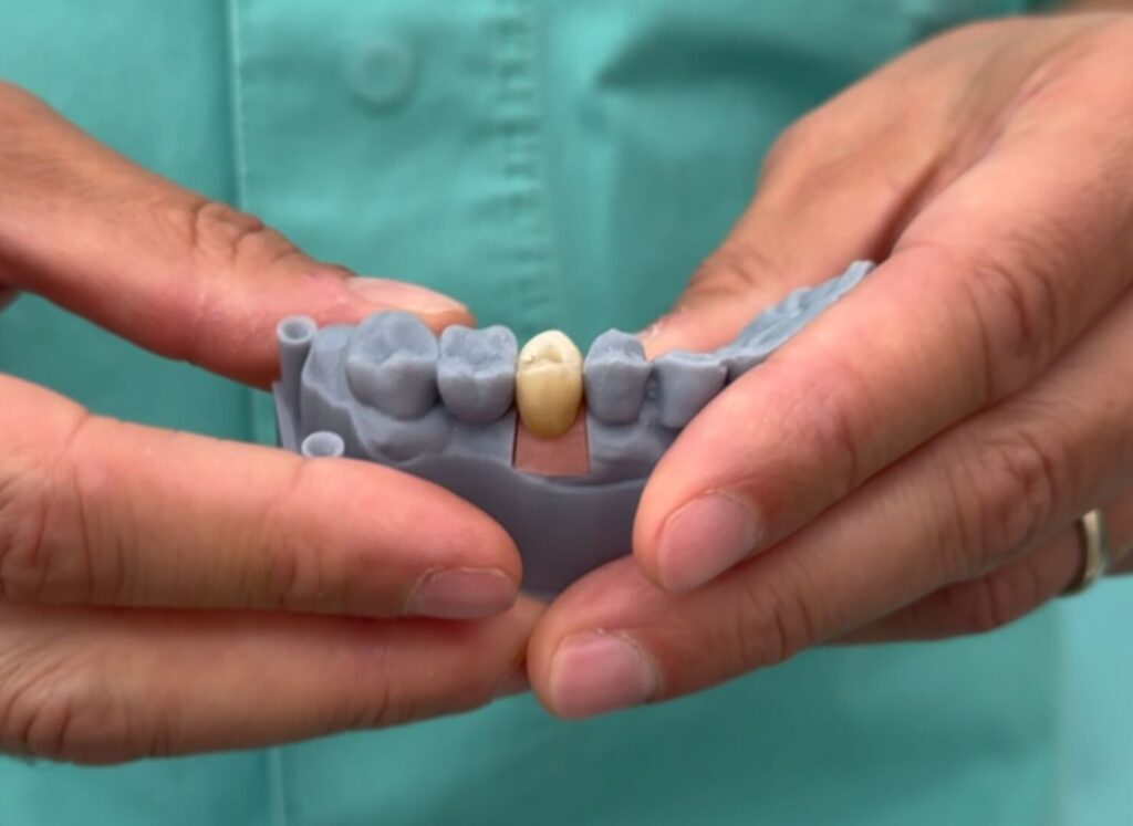Tipi di impianti dentali oggi disponibili